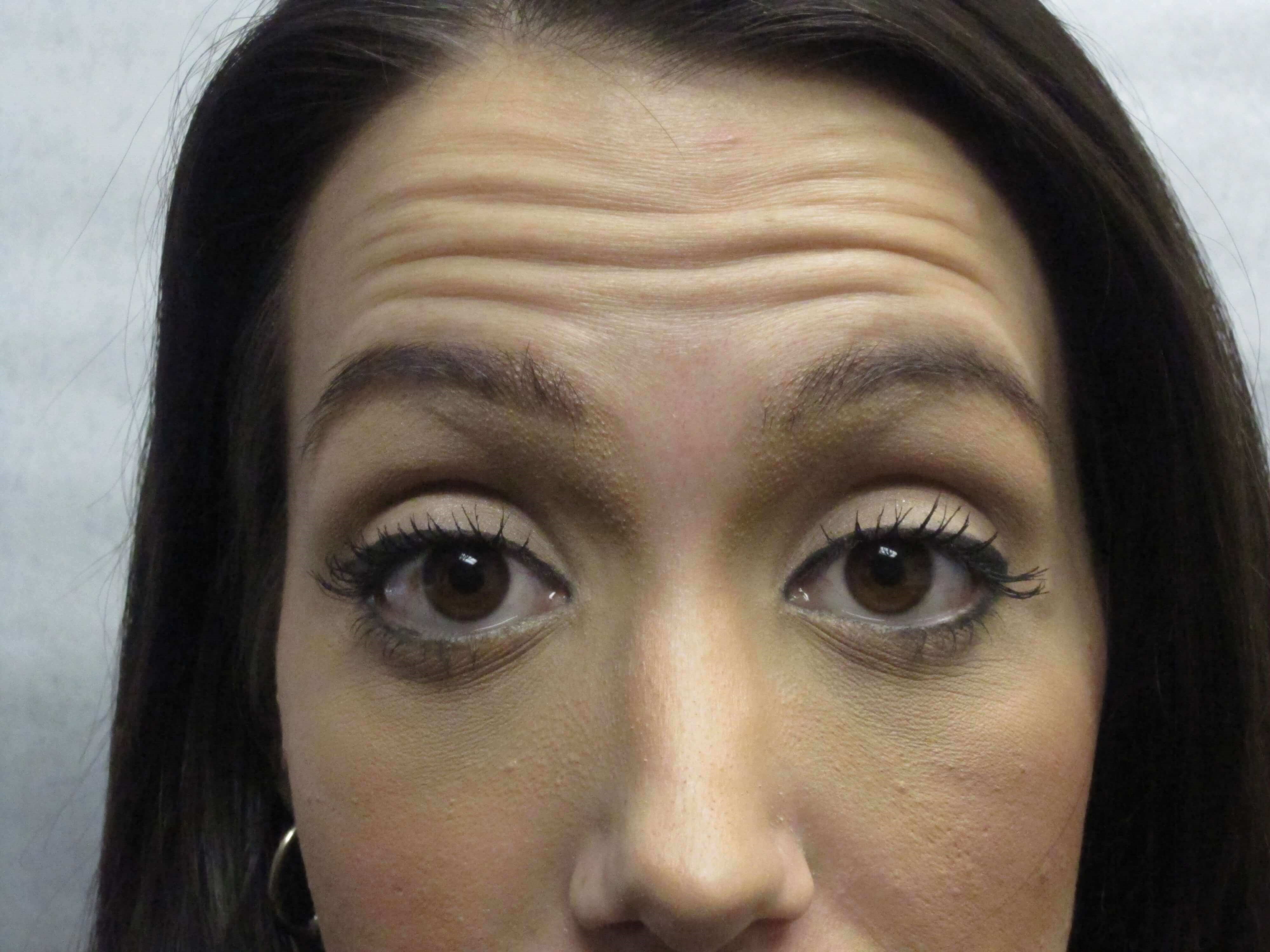 Botox Before