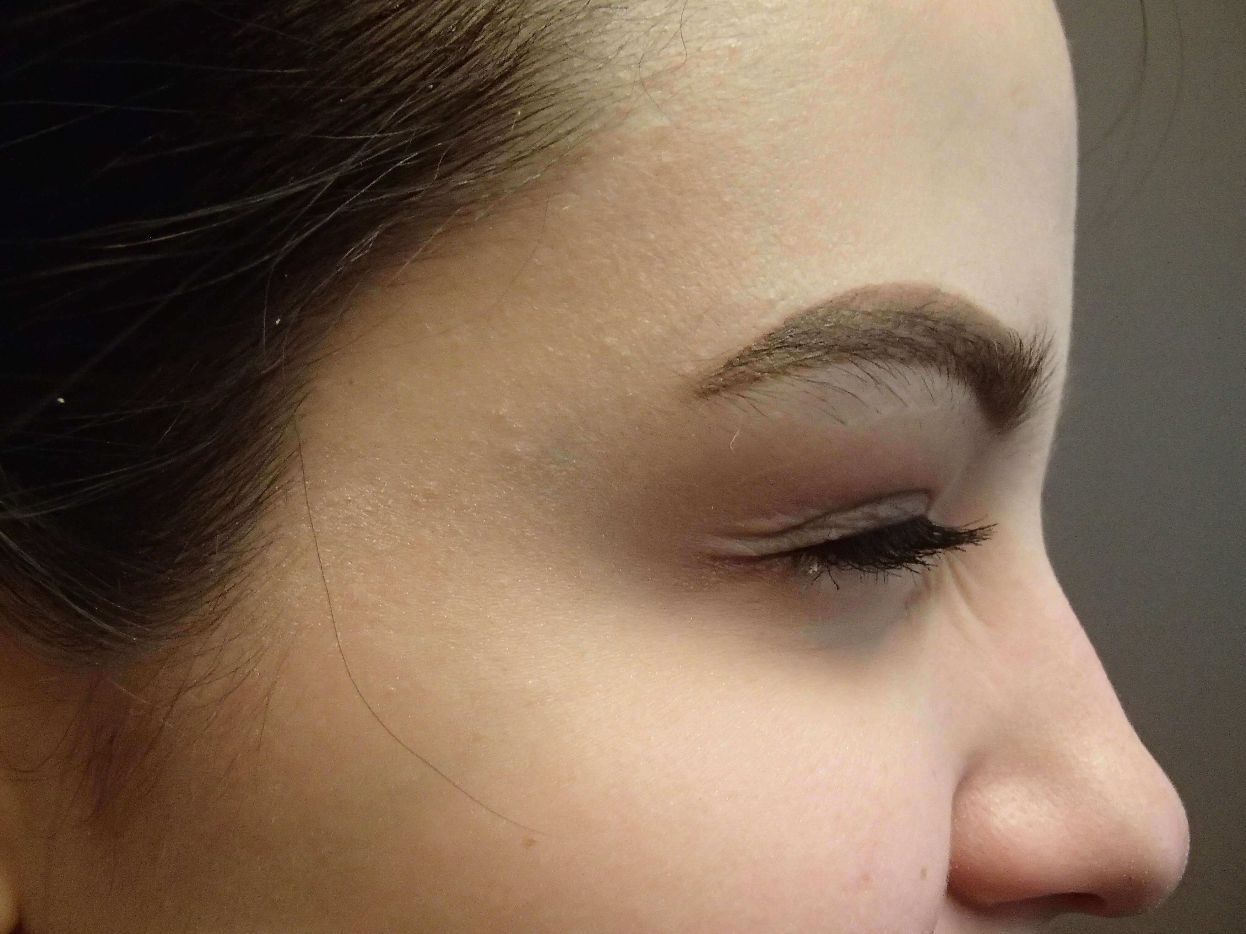 Botox After