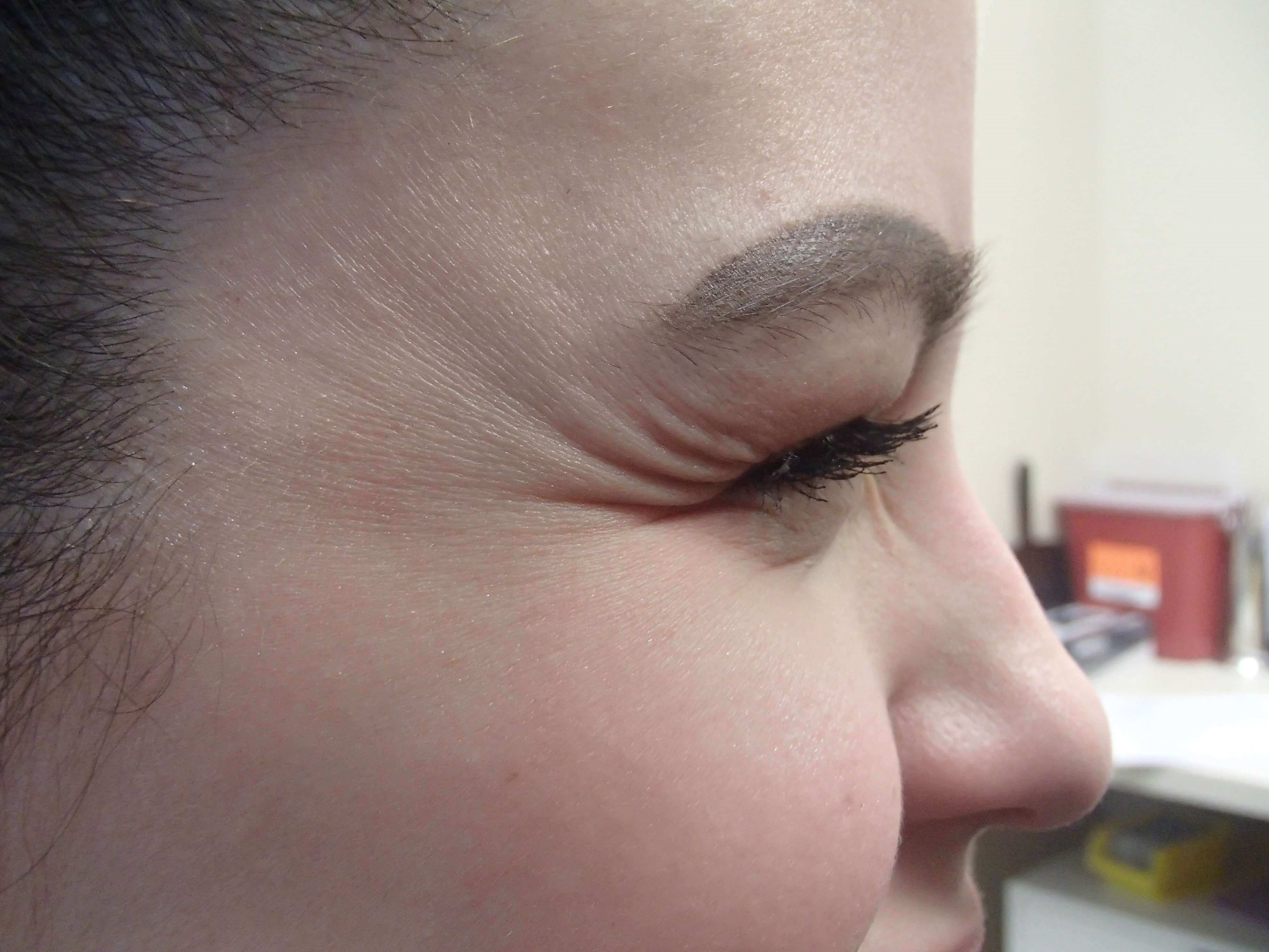 Botox Before