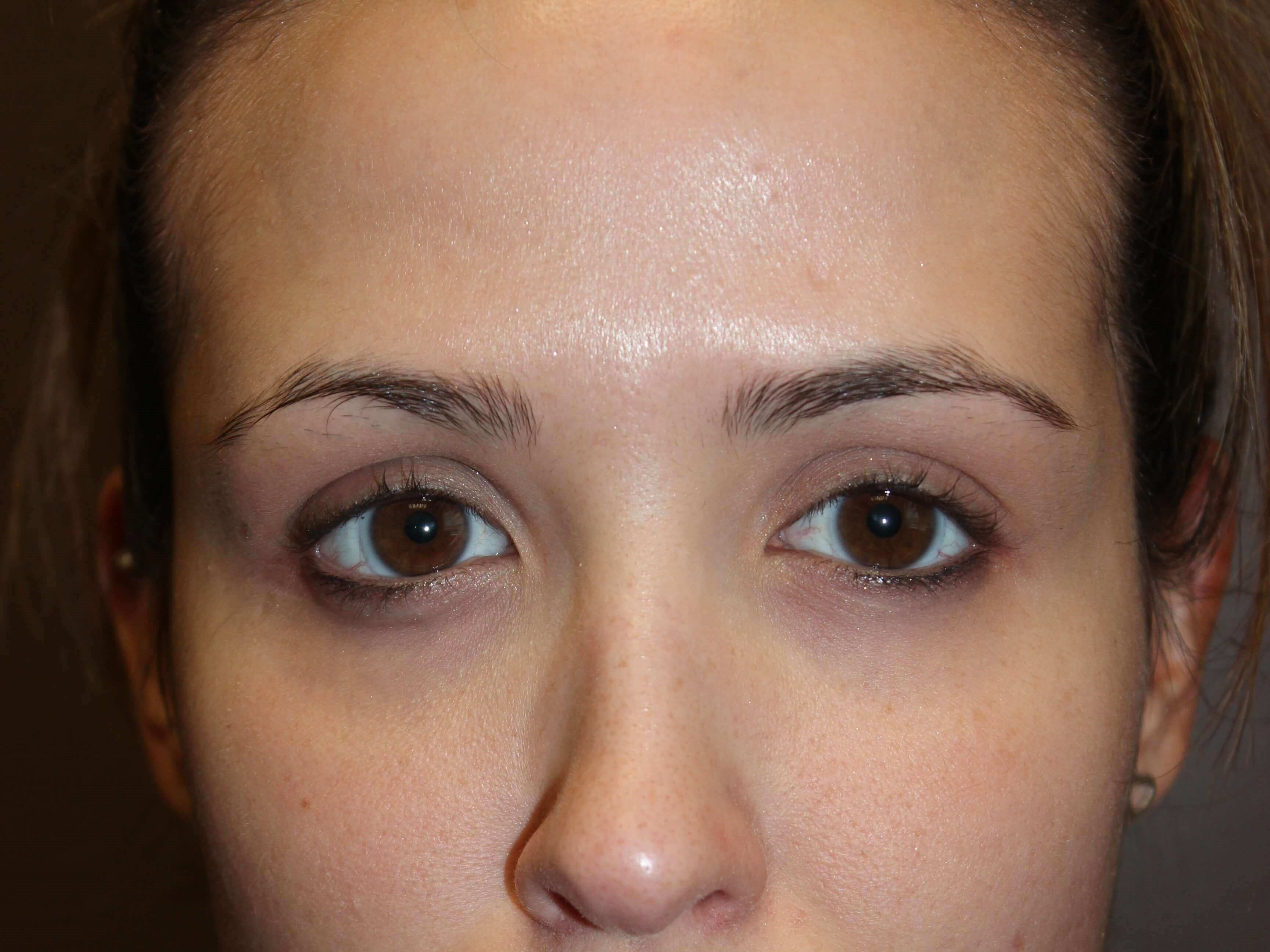 Radiesse After