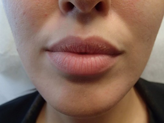 Juvederm Before