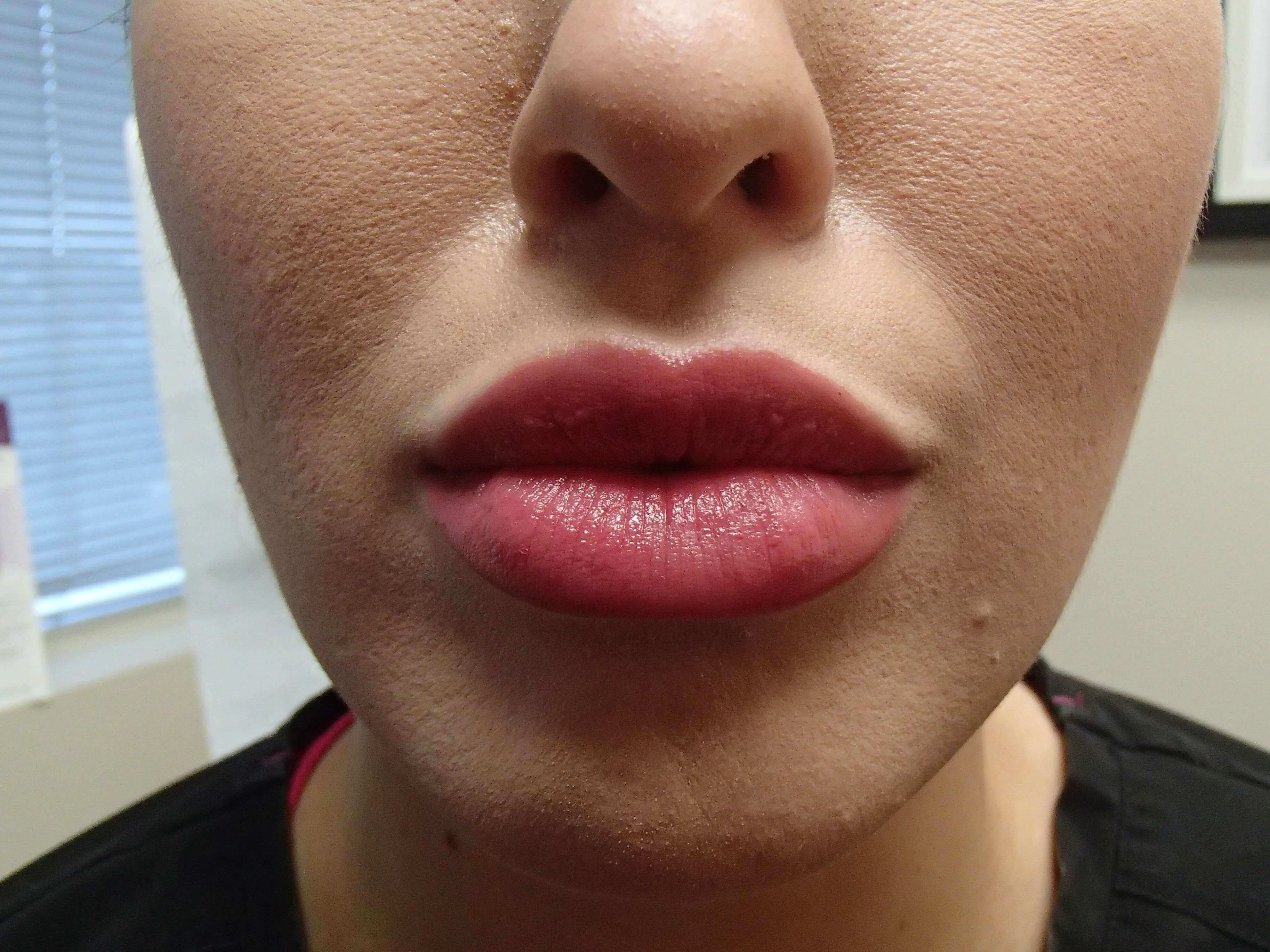 Juvederm After
