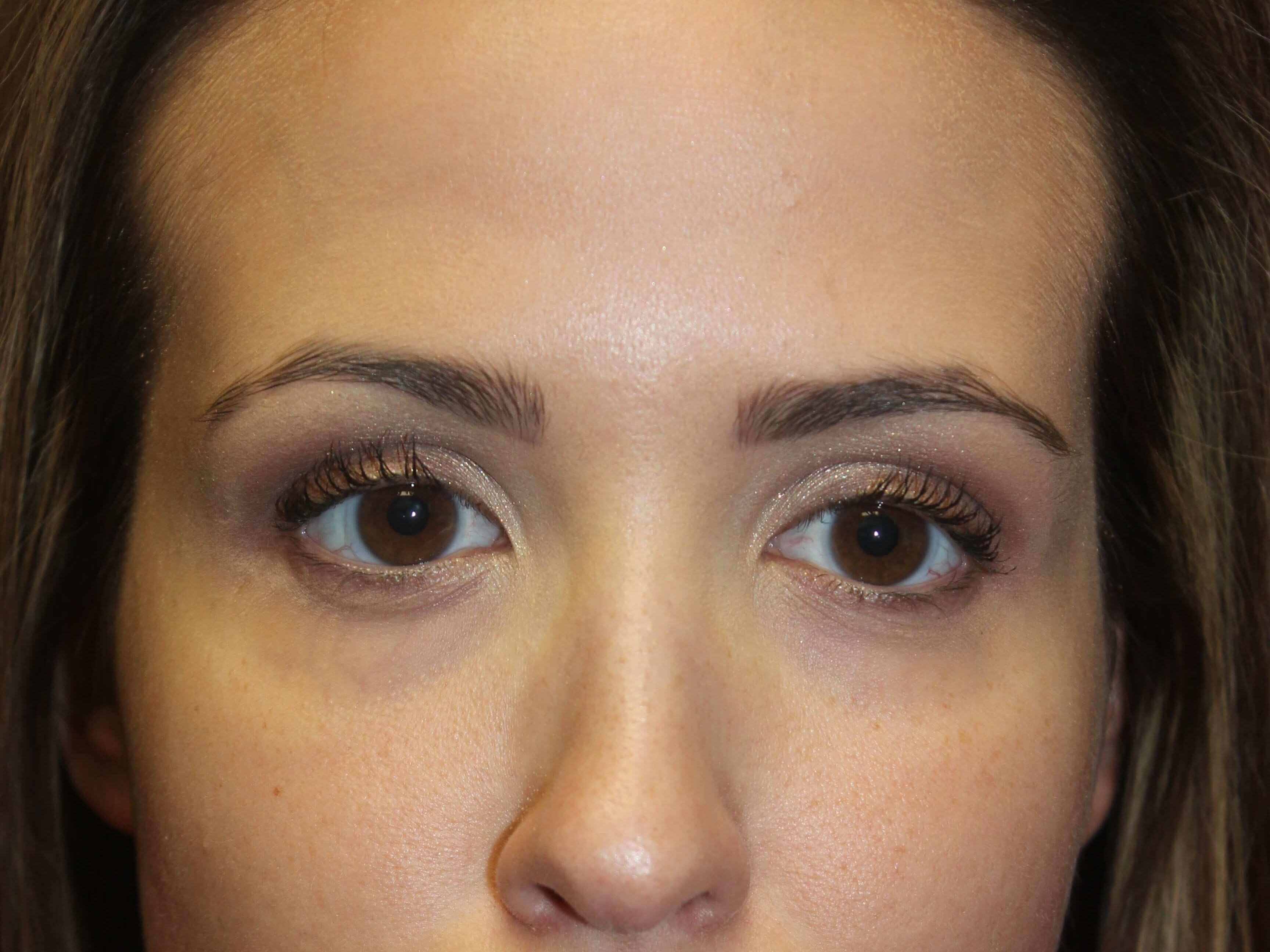 Radiesse Before
