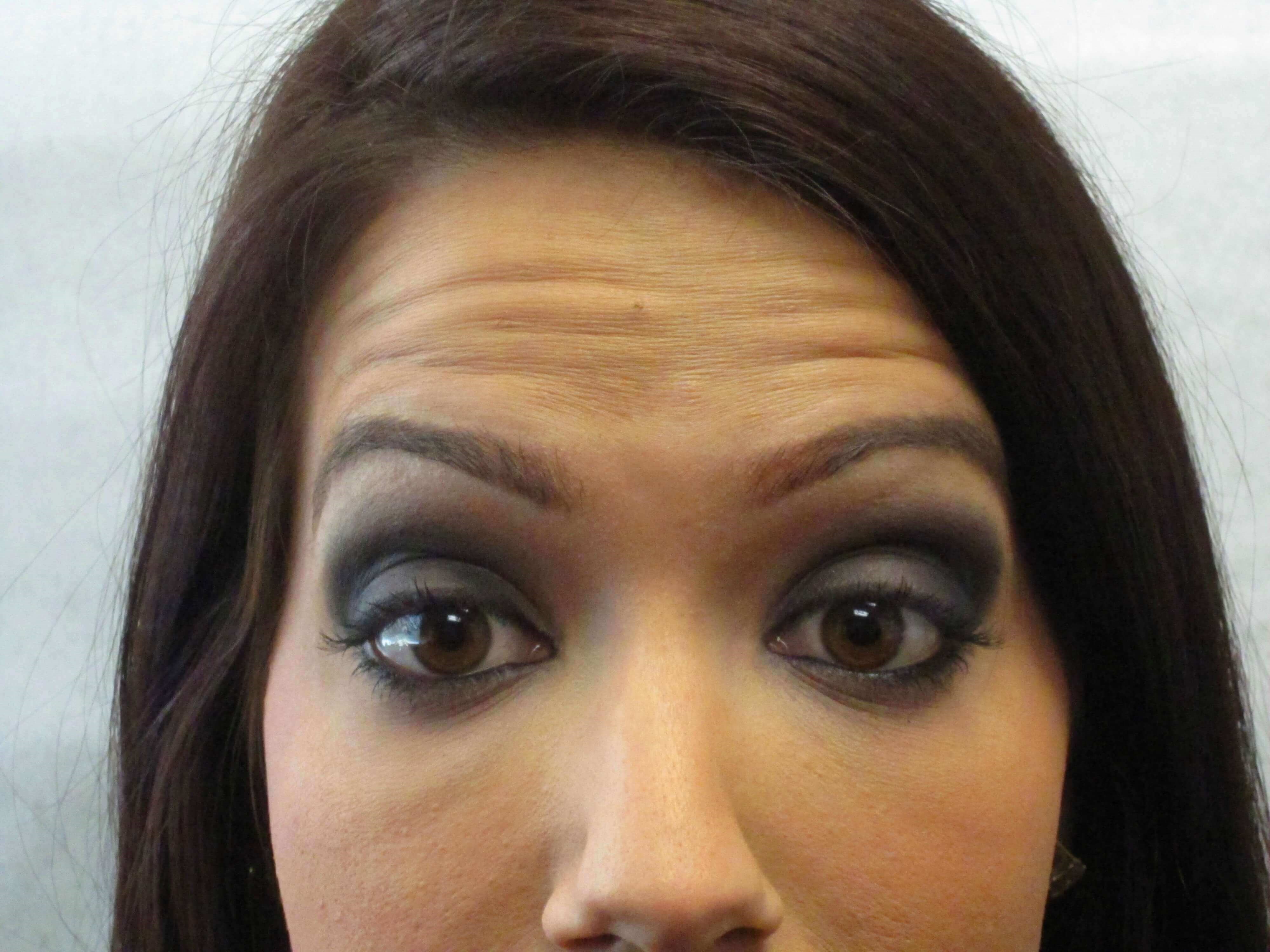 Botox Before