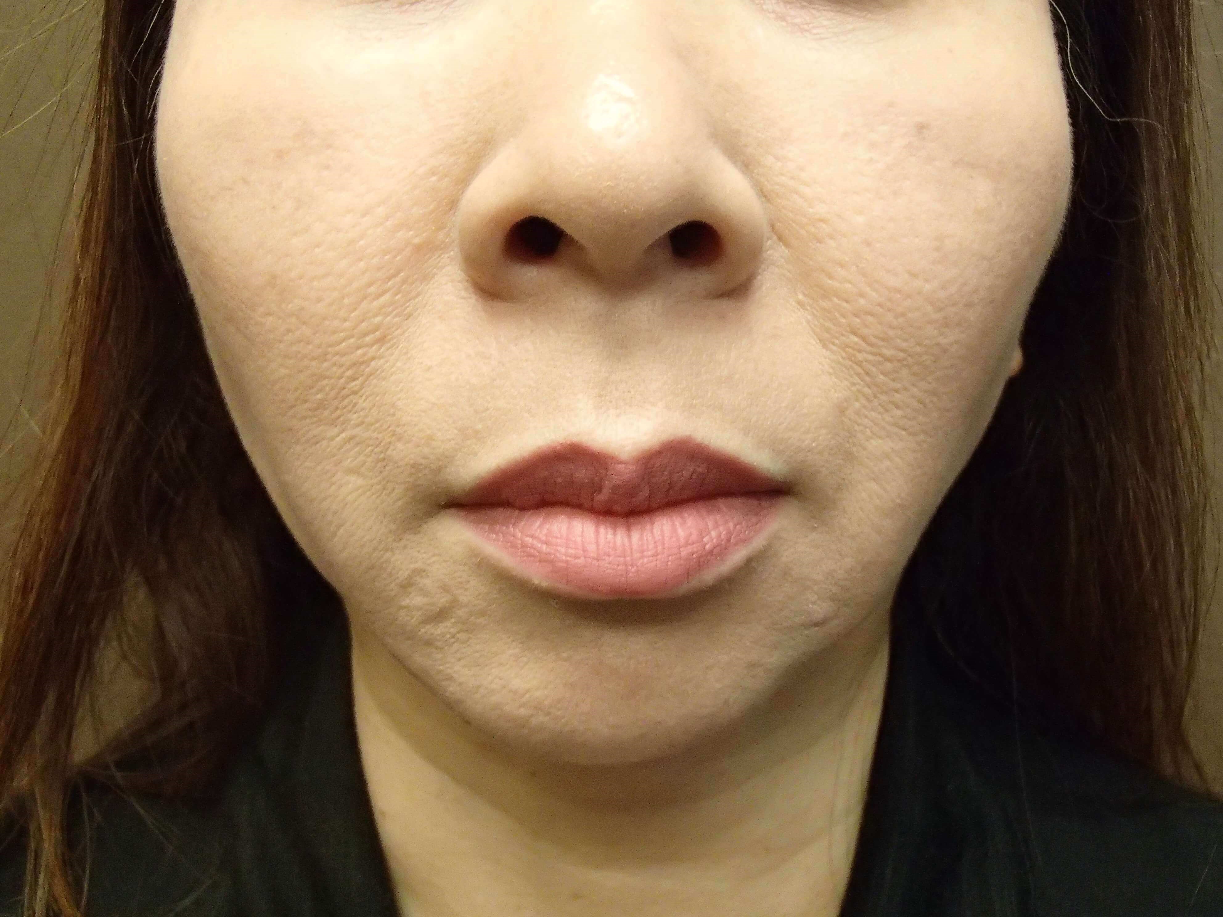 Liposuction After