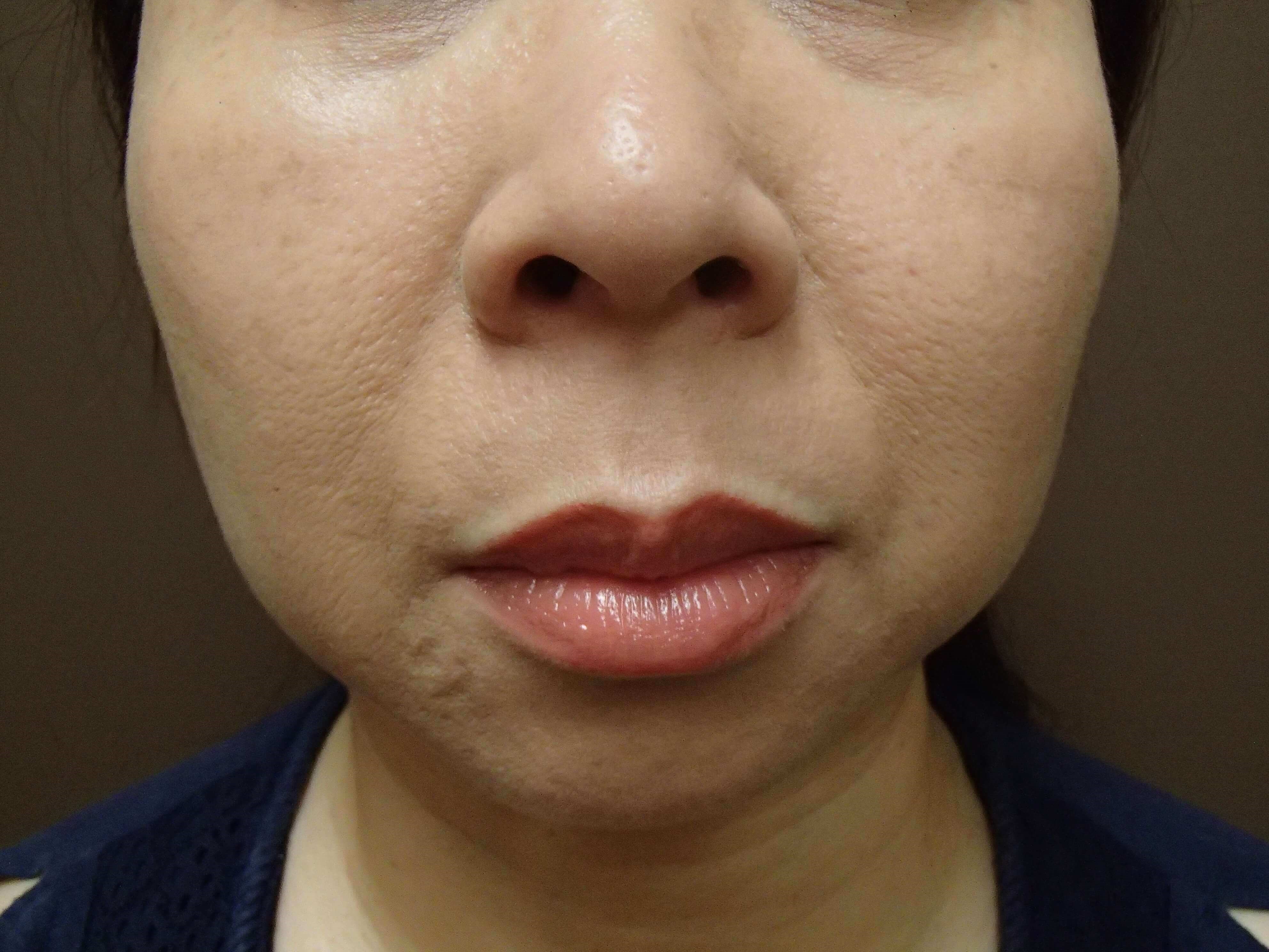 Liposuction Before