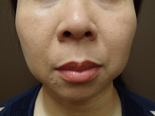 Liposuction Before