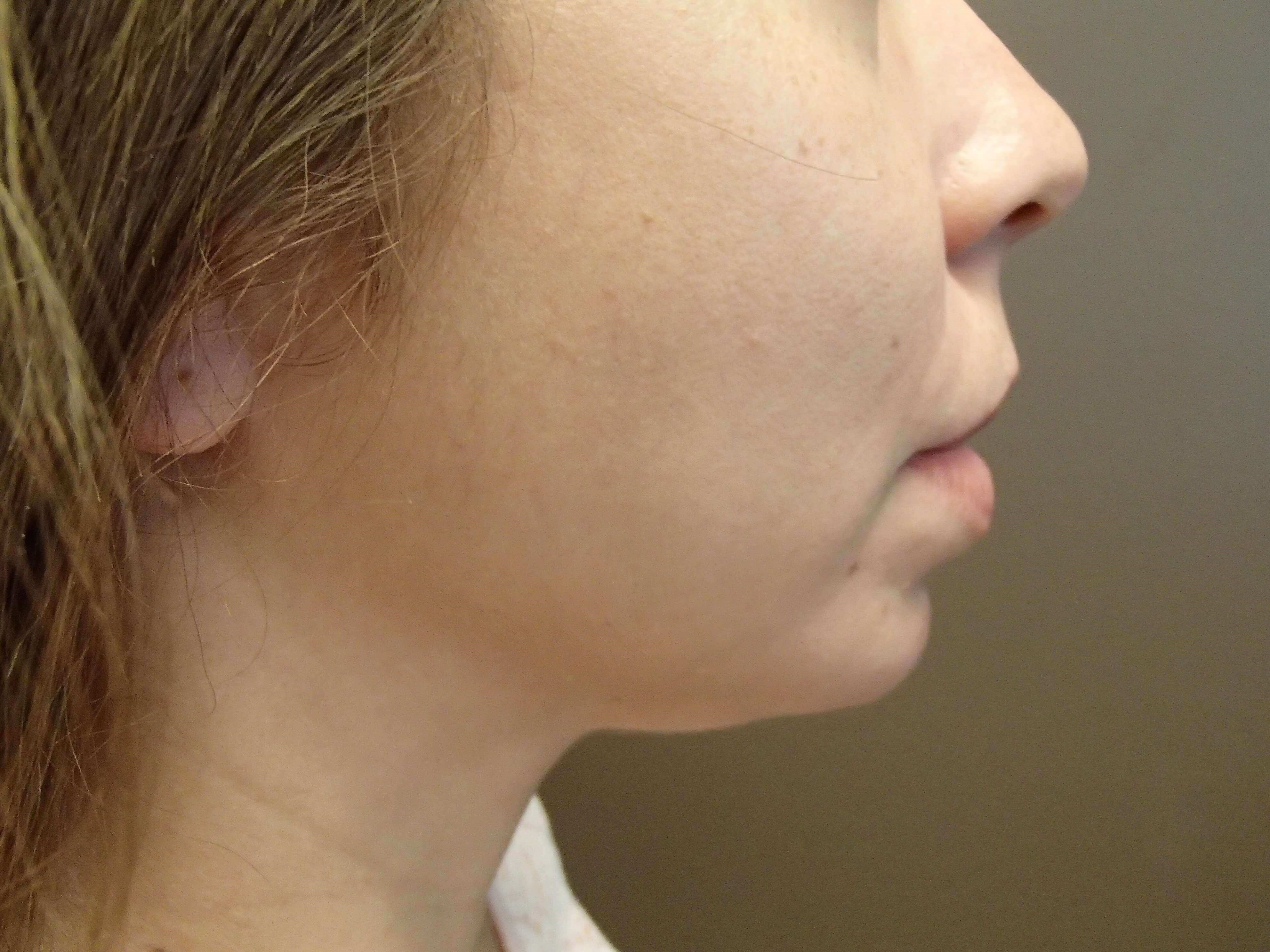 Kybella Before