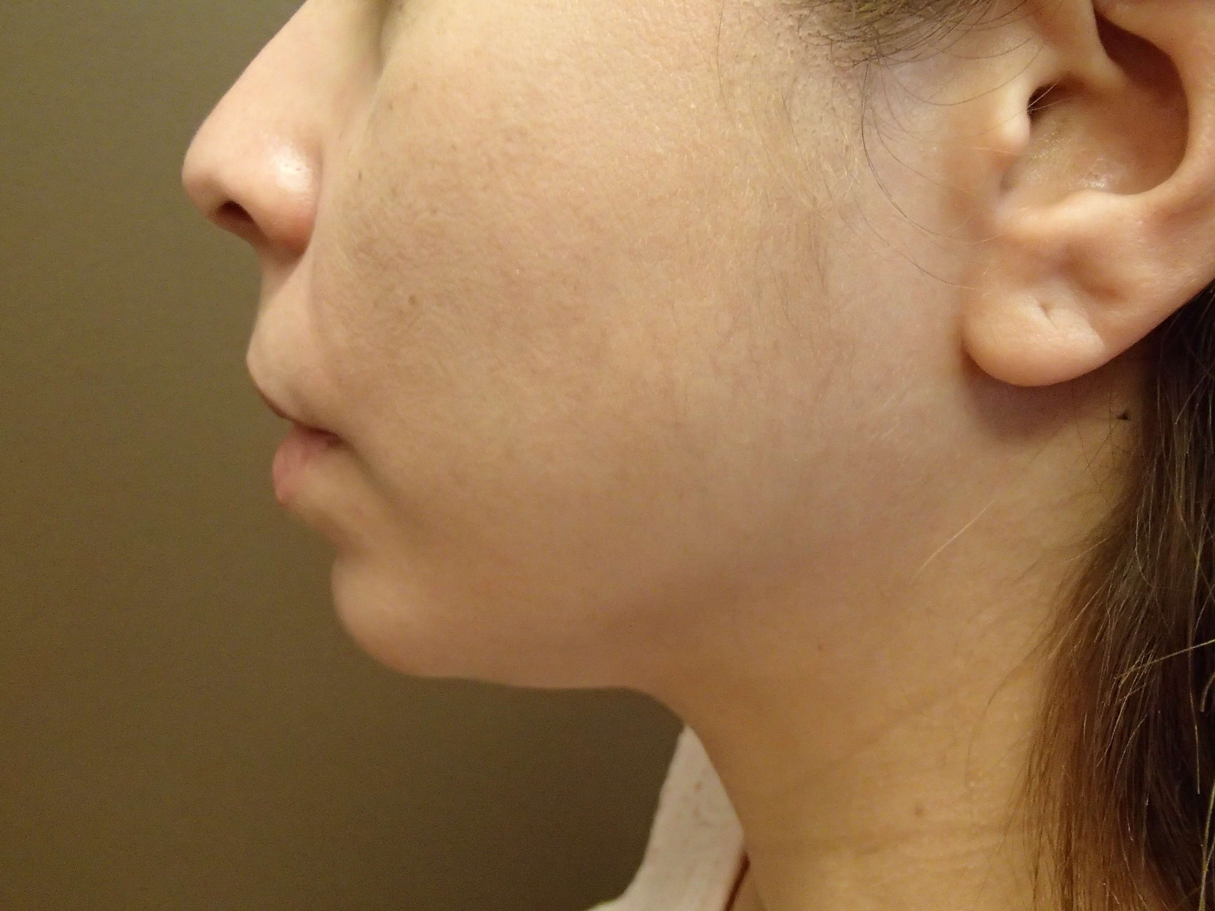 Kybella Before