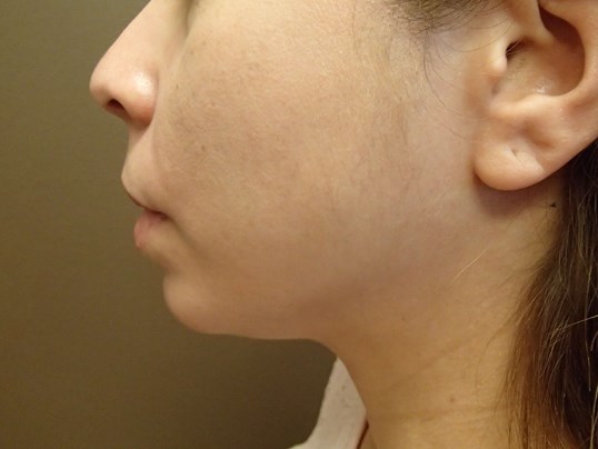 Kybella Before