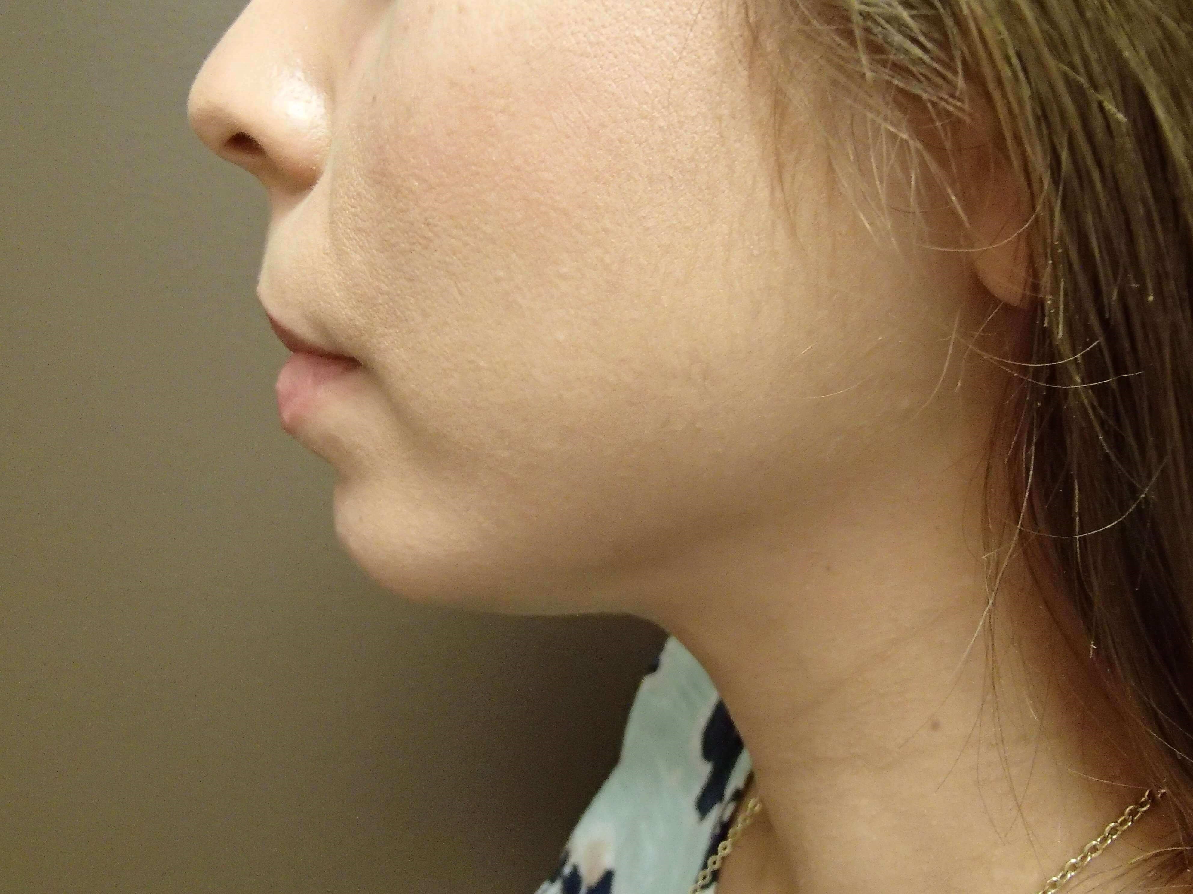 Kybella After
