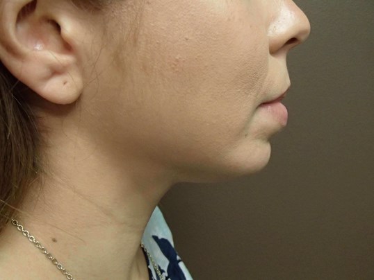 Kybella After