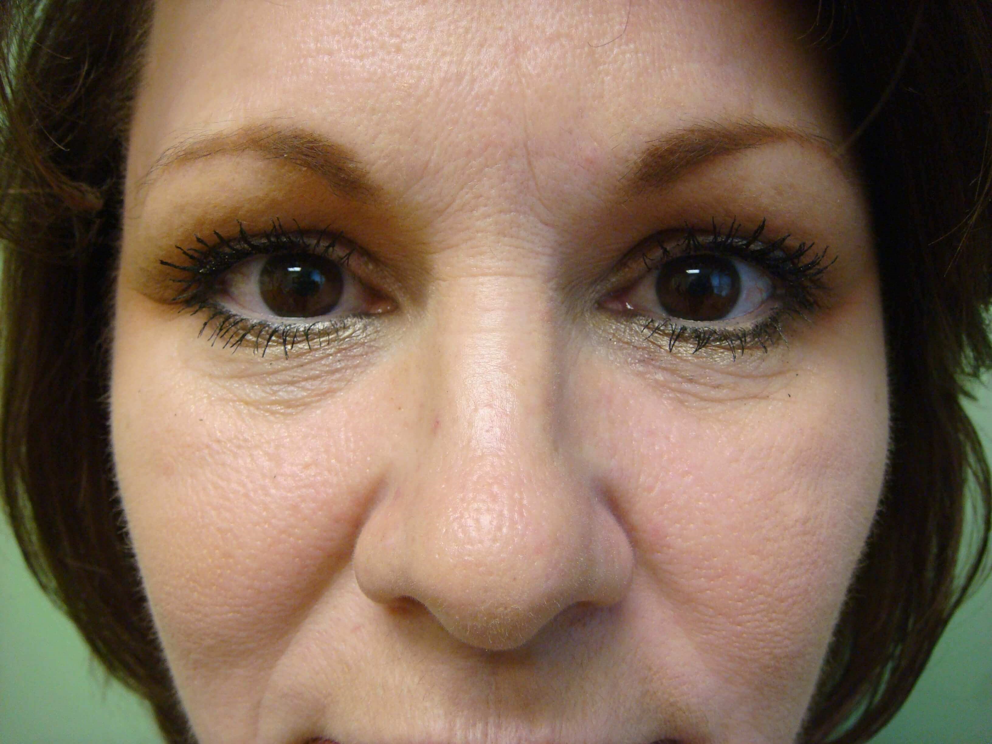 Juvederm Before