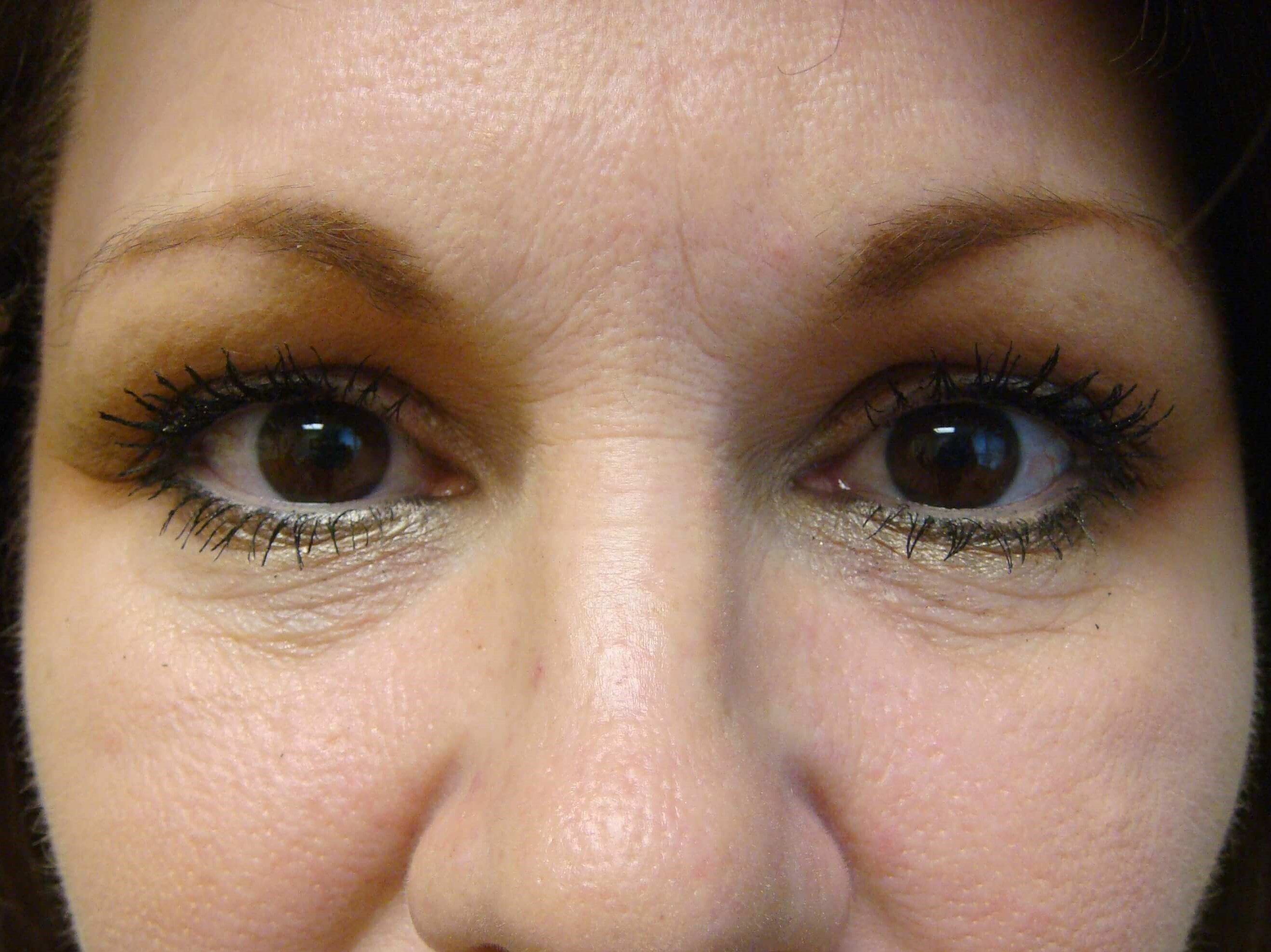 Juvederm Before