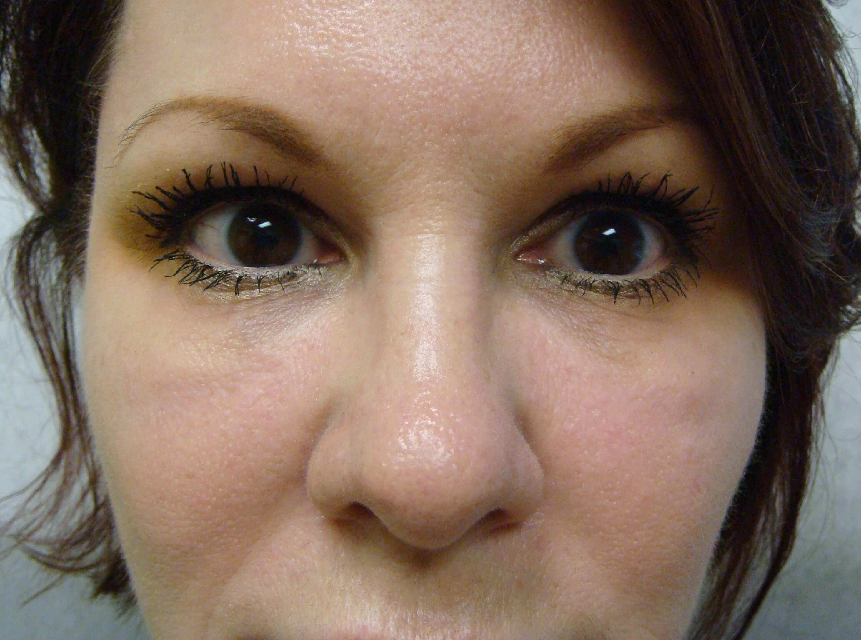 Juvederm After
