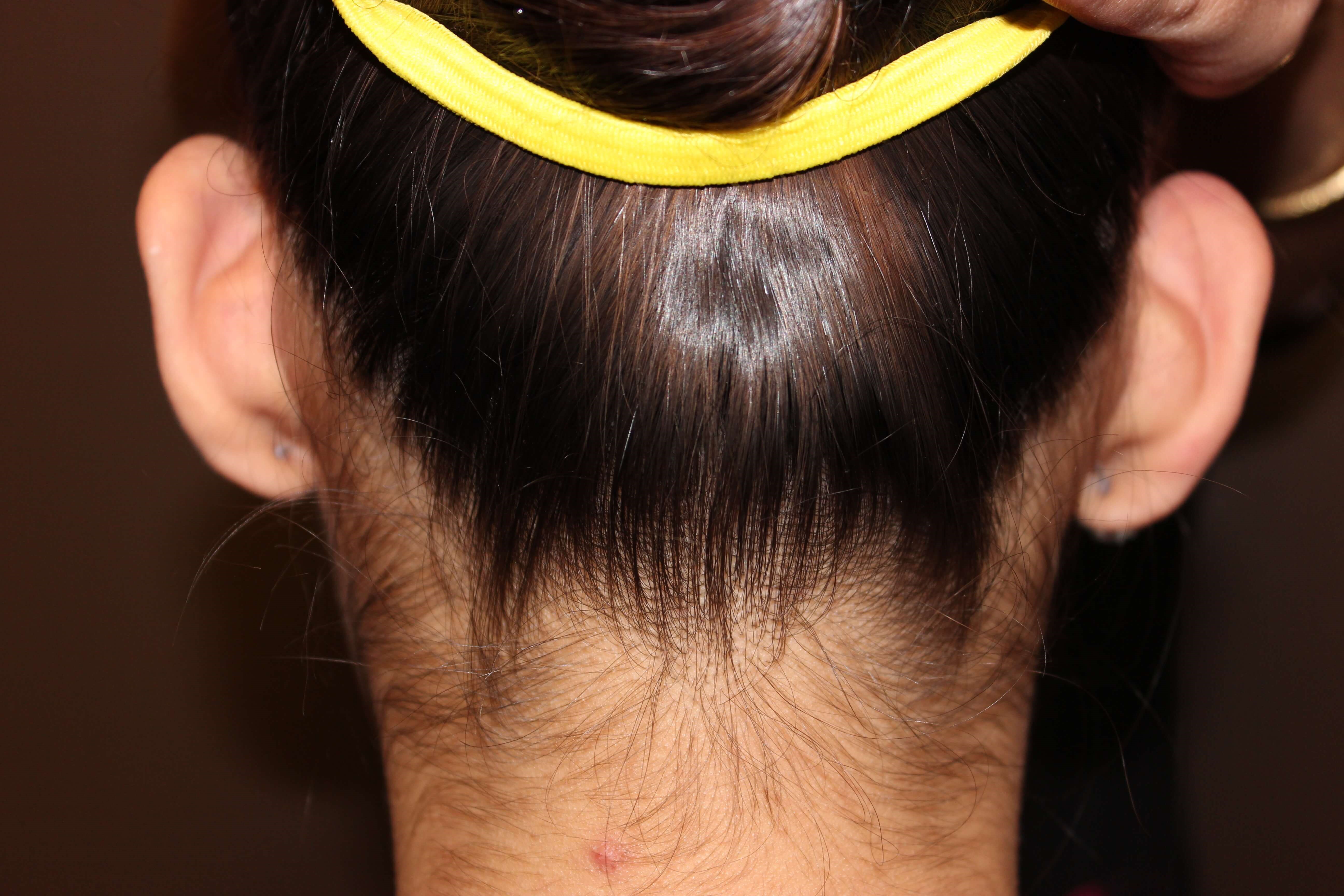 Otoplasty Before