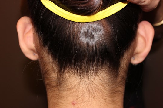 Otoplasty Before