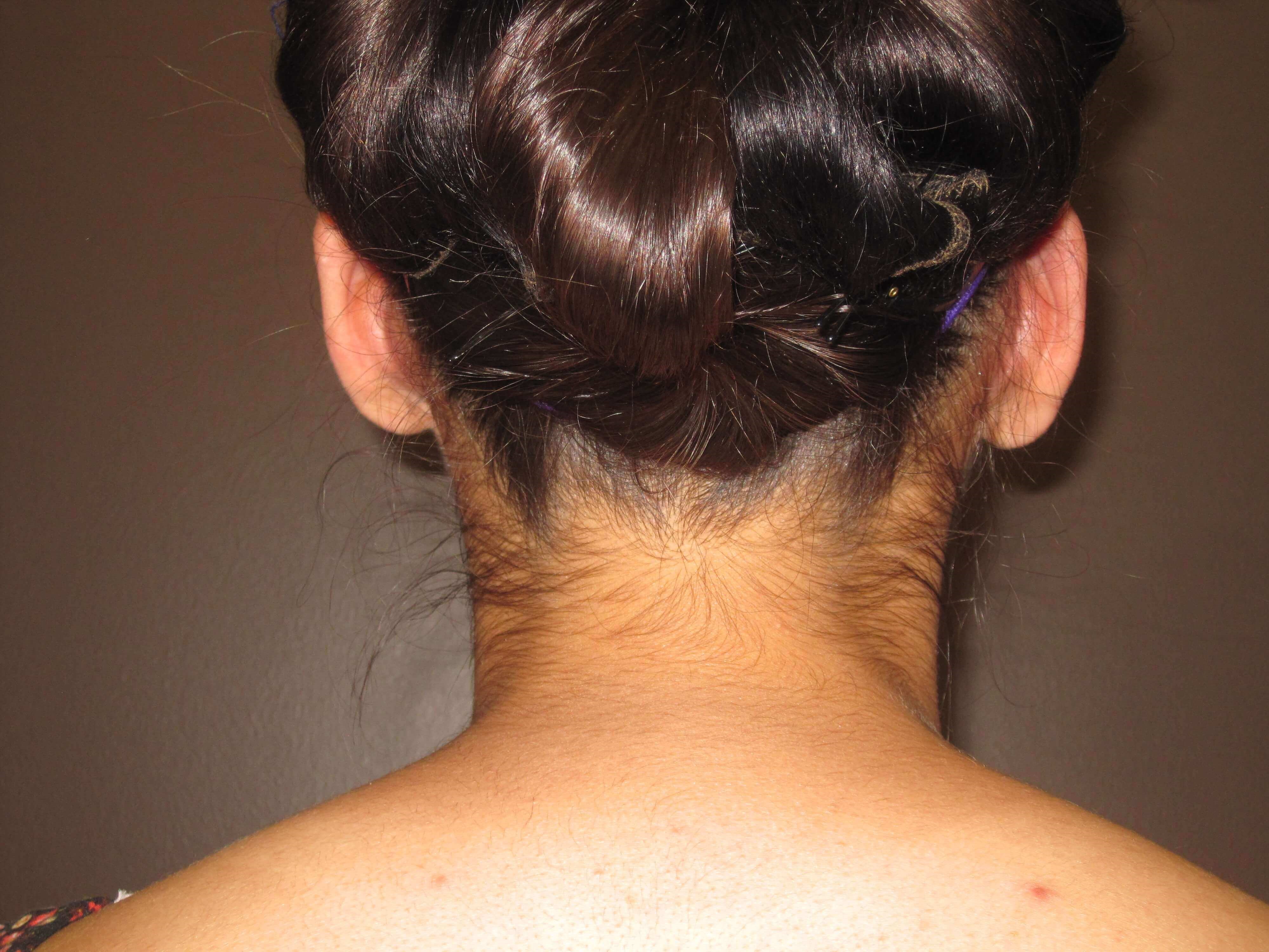 Otoplasty After