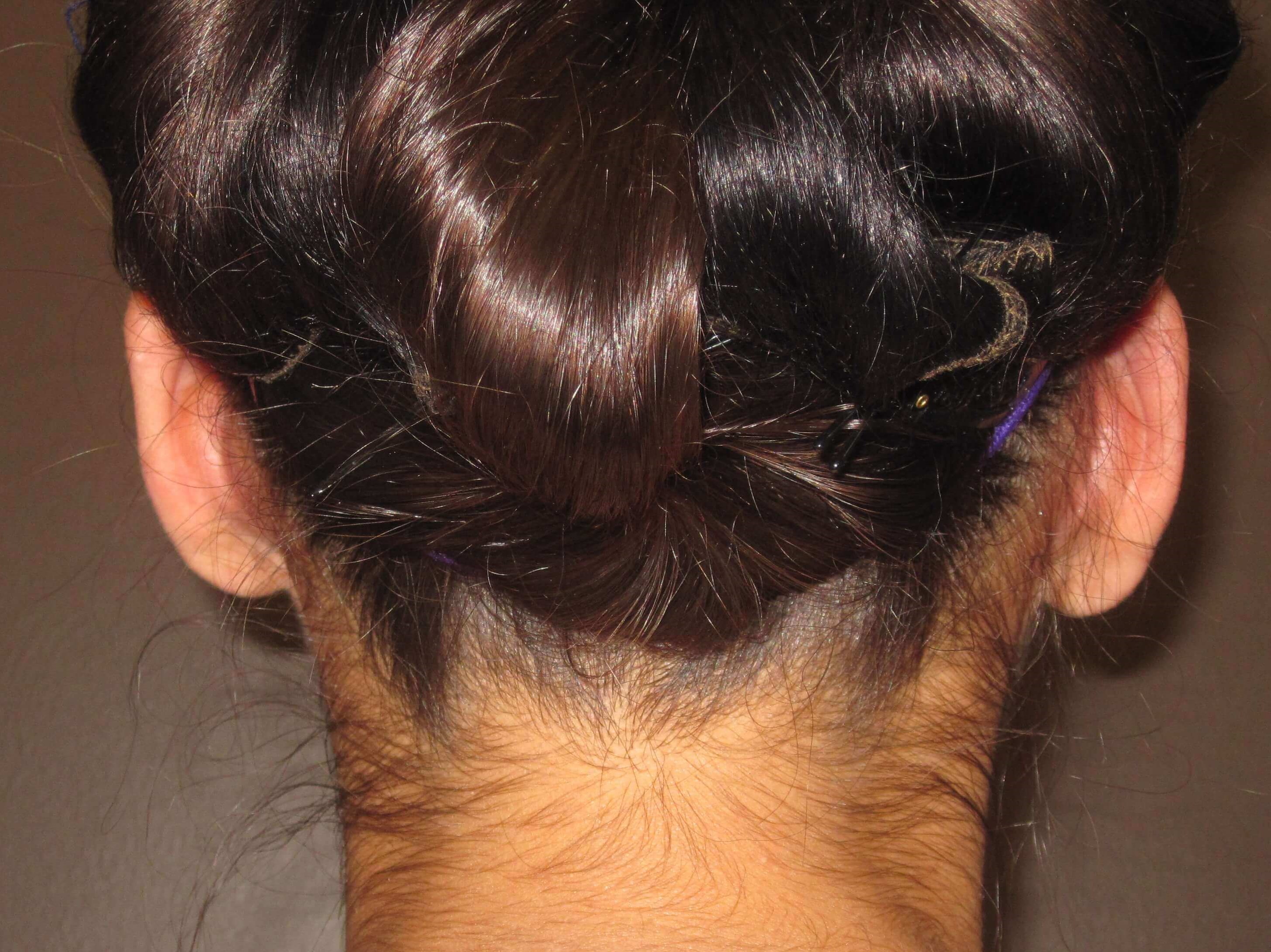 Otoplasty After