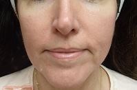 Juvederm After