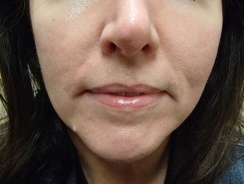 Juvederm Before