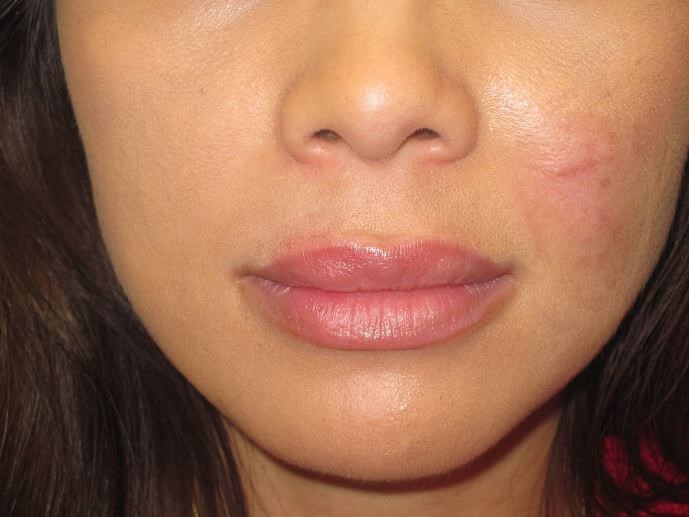 Juvederm After