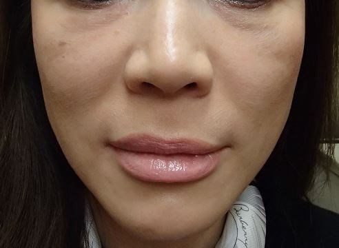 Juvederm Before