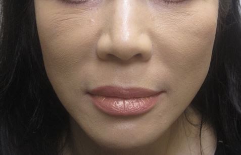 Juvederm After