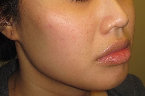 Juvederm After
