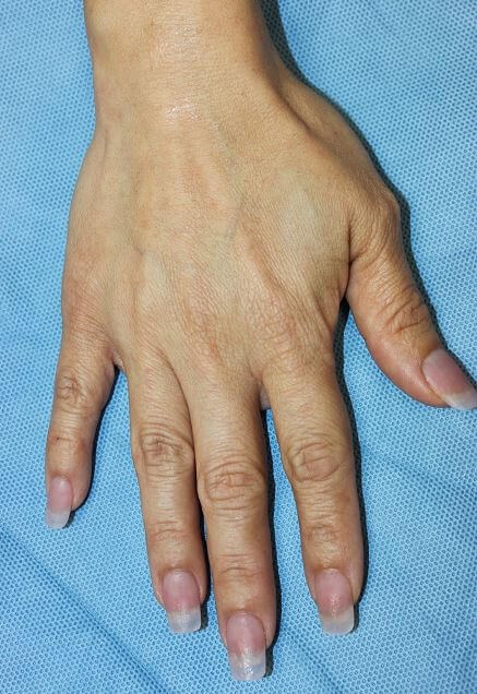 Radiesse Before