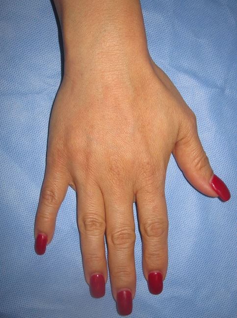 Radiesse After