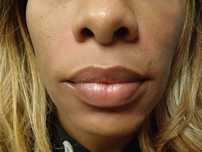 Radiesse and Restylane After