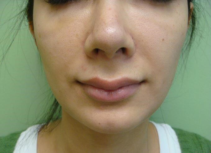 Juvederm Before