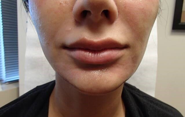 Juvederm After