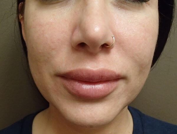 Juvederm After