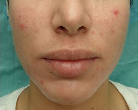 Juvederm Before