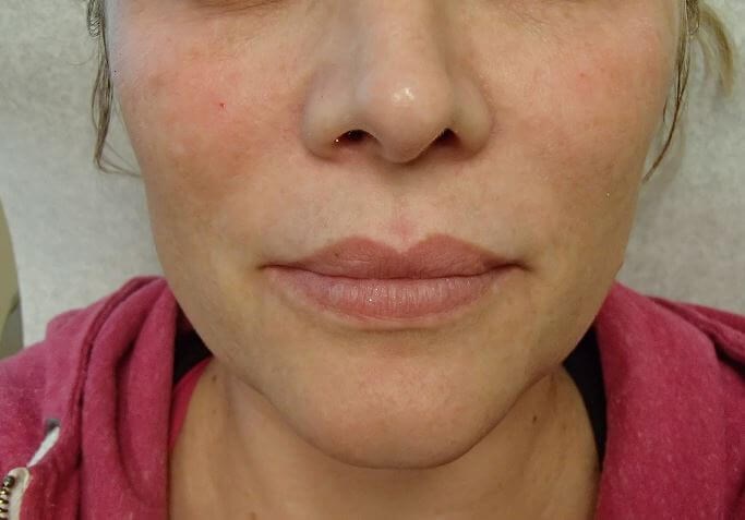 Juvederm Before