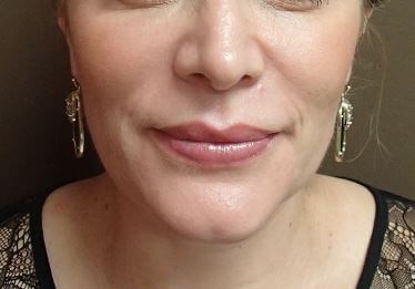 Juvederm After