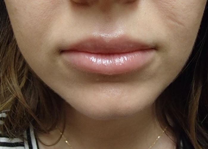 Juvederm After