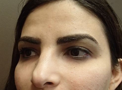 Juvederm and Restylane After