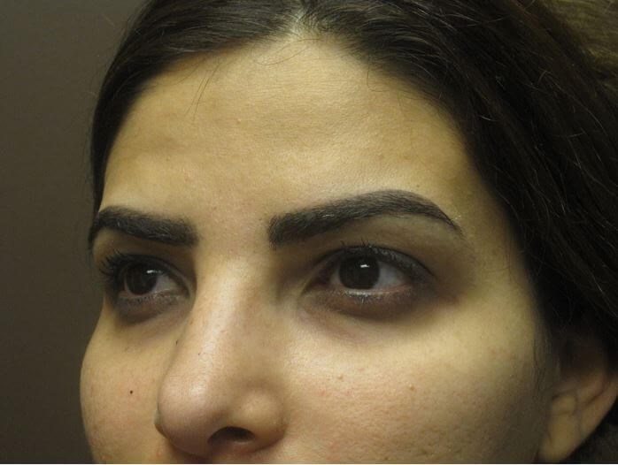 Juvederm and Restylane Before