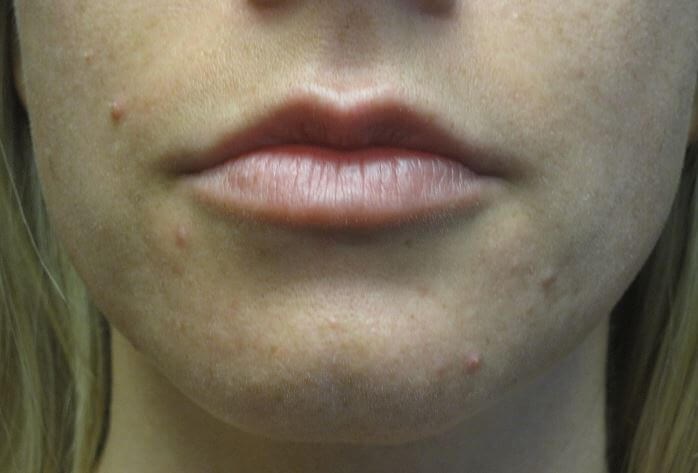 Juvederm After