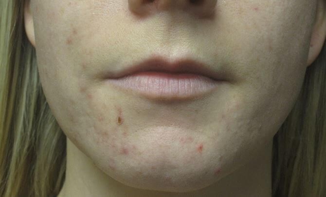 Juvederm Before