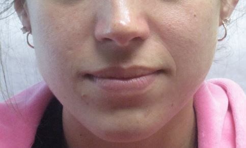 Juvederm Before