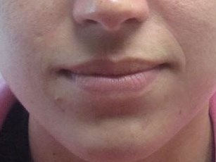 Juvederm Before