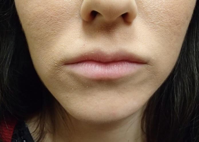 Juvederm Before