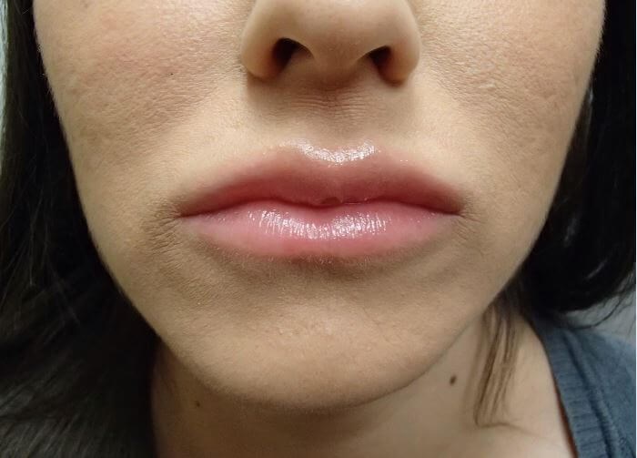 Juvederm After