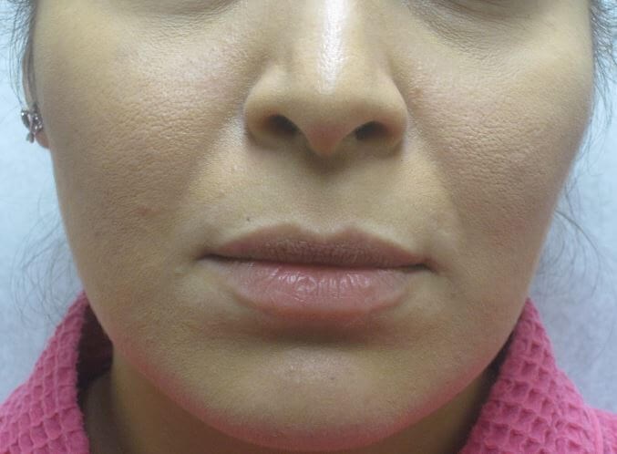 Juvederm Before