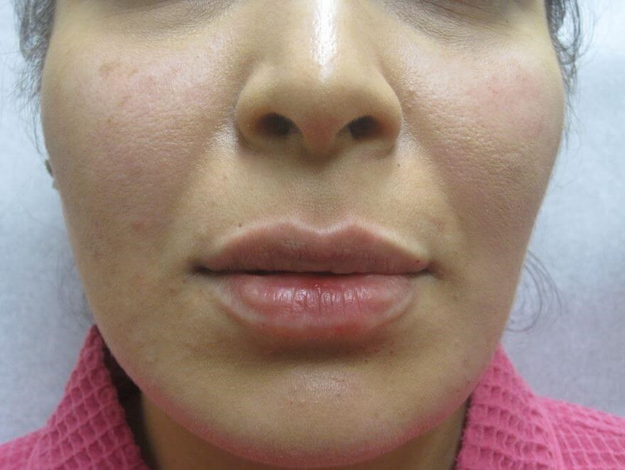 Juvederm After
