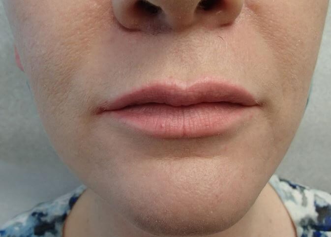 Juvederm After